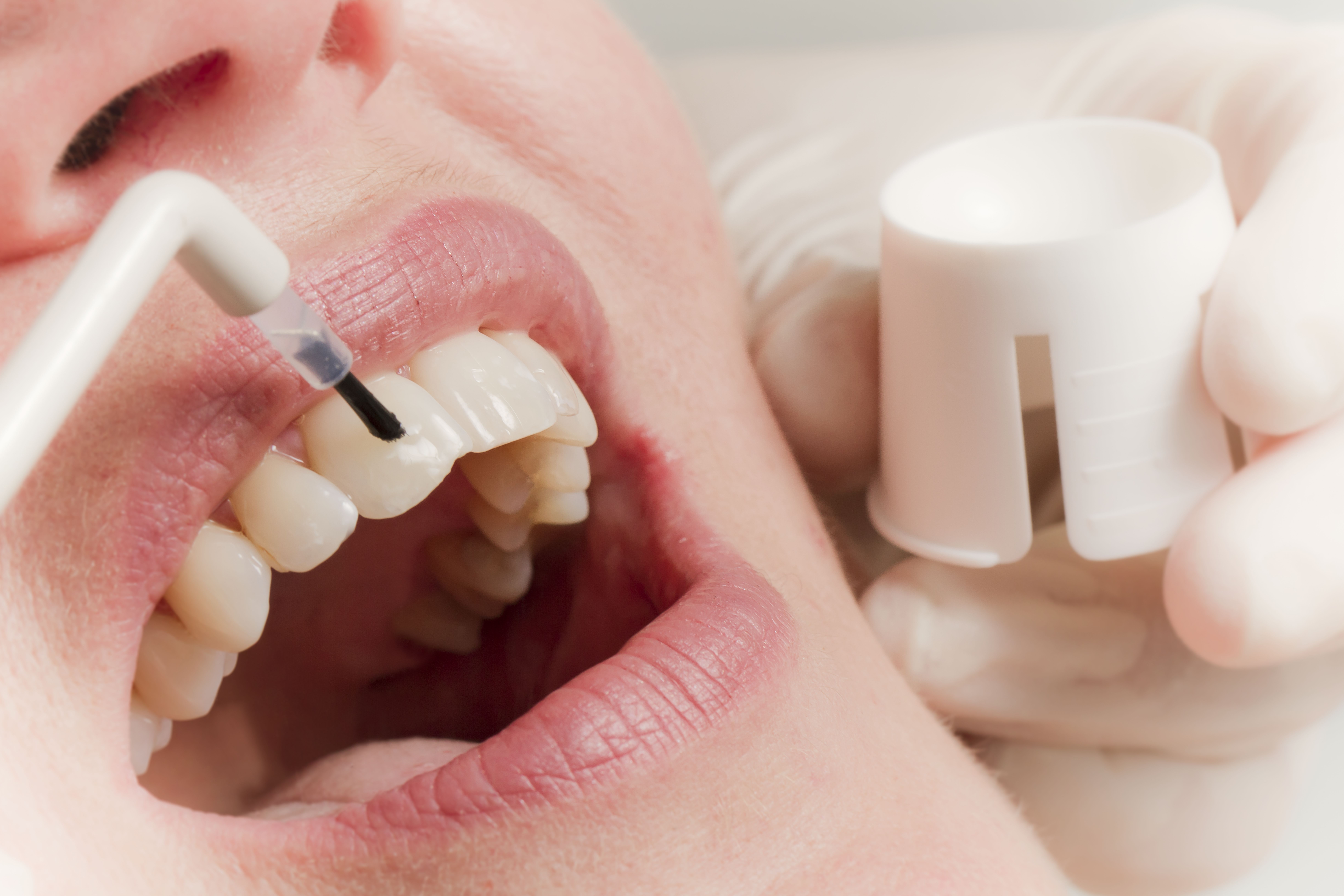 Гигиена полости рта стоимость. Реминерализующая терапия глубокое фторирование. Реминерализация зубов кариес. Глубокое фторирование, 1 зуб что это. Глубокое фторирование эмали зубов.