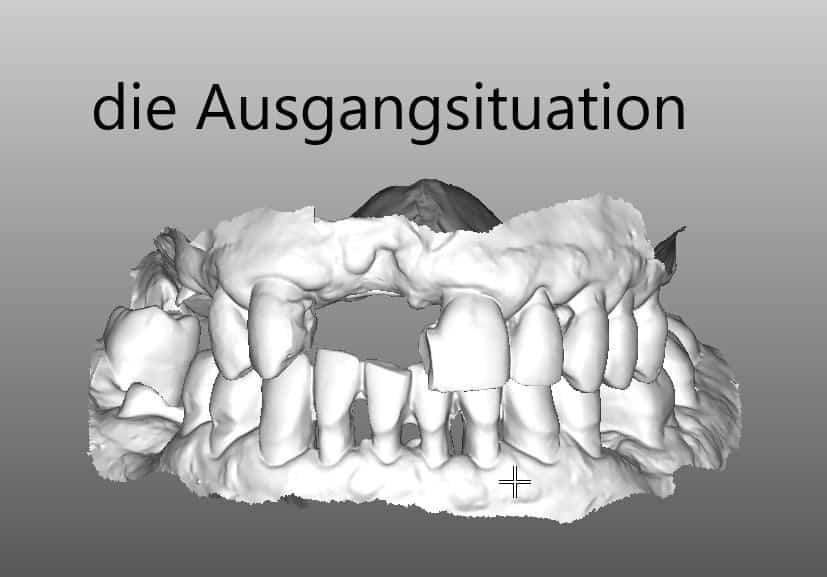 digitales Röntgenbild zeigt fehlende Zähne