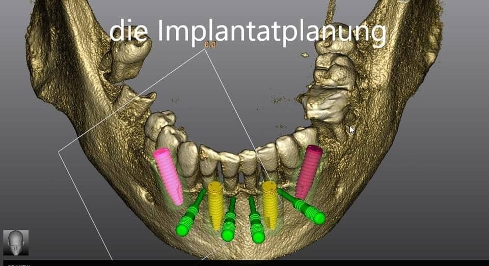 Dr. Schmidt plant Implantate im Unterkiefer