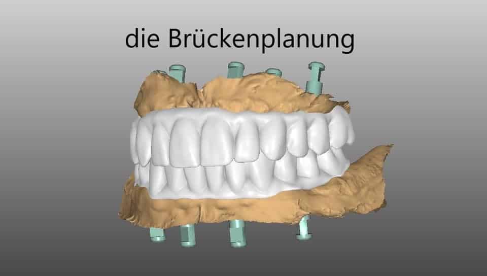 Dr. Schmidt plant Brücke als Zahnersatz