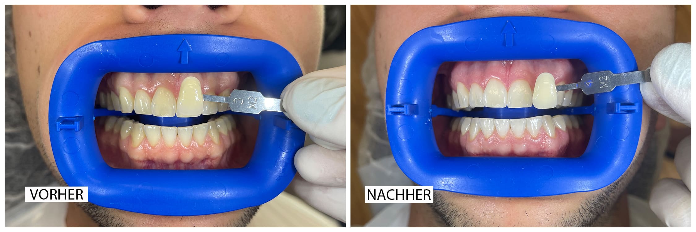 Bleaching Vergleich Vorher Nachher Zahnarzt Dr. Schmidt