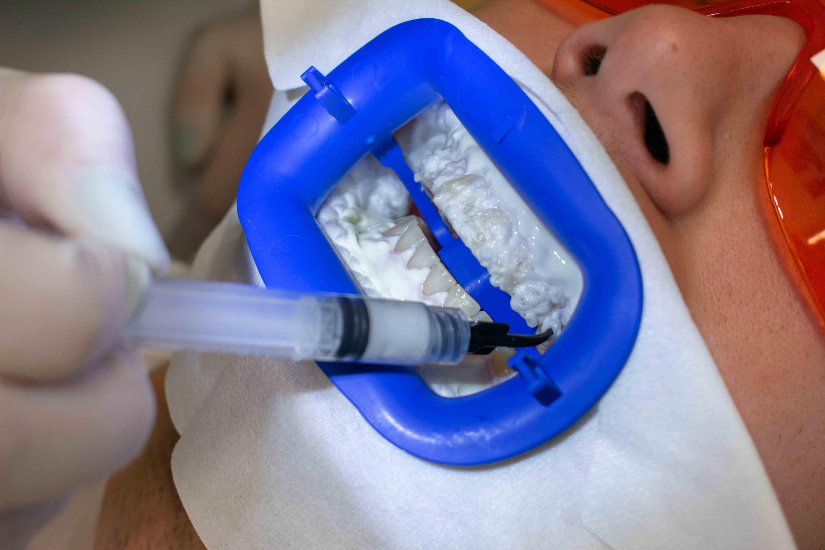 Bleaching Gel weiße Zähne Dr. Marc Schmidt
